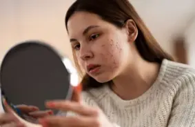 Pusaudžu akne: Kā vecāki var palīdzēt savam bērnam tikt galā ar ādas problēmām un saglabāt pašapziņu