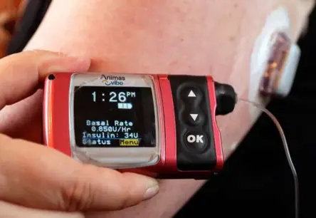 Glikozes sensori un insulīna sūkņi Latvijā: greznība vai dzīvības glābēji?