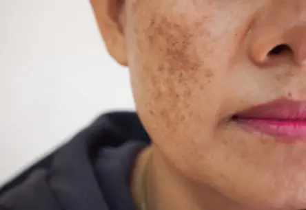 Tumšie plankumi uz sejas: cēloņi, veidi un efektīvi risinājumi