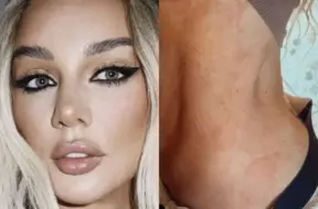 Anna Sedokova cīnās ar nātres uzliesmojumu: gandrīz noģība uz skatuves