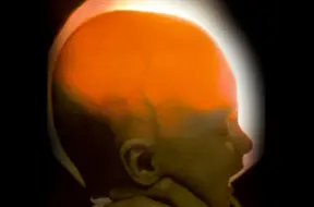 Brīnums Nebraskā: Meitene, kurai piedzimstot nebija lielākās daļas smadzeņu, svin 20. dzimšanas dienu