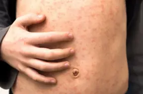 Kanāda atkal saskaras ar masalām: zaudēts ar vīrusu saistītais izskaušanas statuss