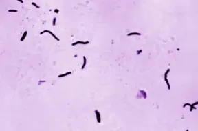 TB gadījumu kritums – cerība vai ilūzija? Eksperti brīdina par finansējuma draudiem